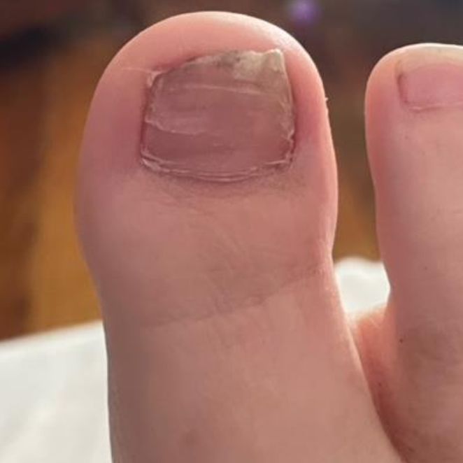 Post-treatment