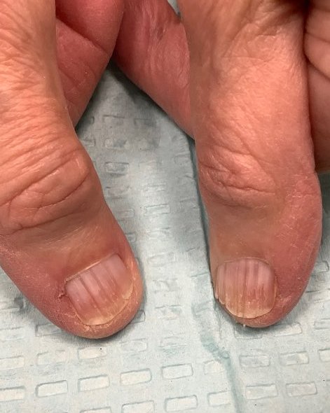Ridged Nails (Onychorrhexis)