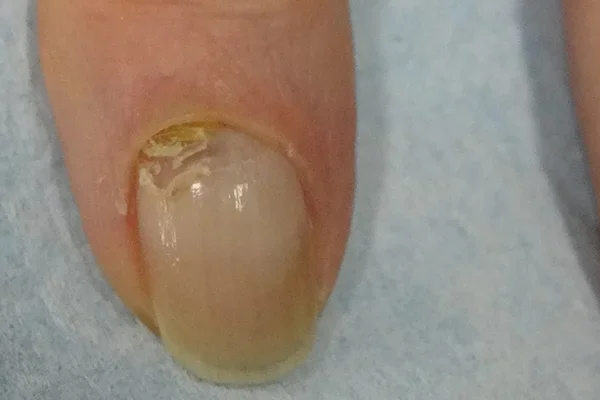 Pre-treatment