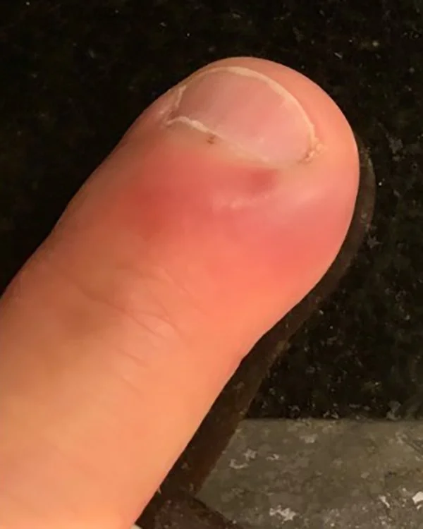 Nail Infection Treatment