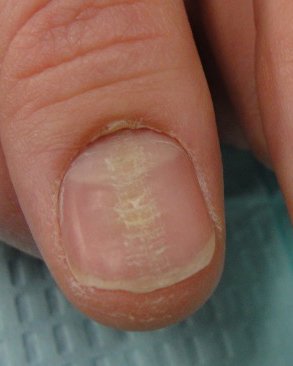 Nail Picking Treatment