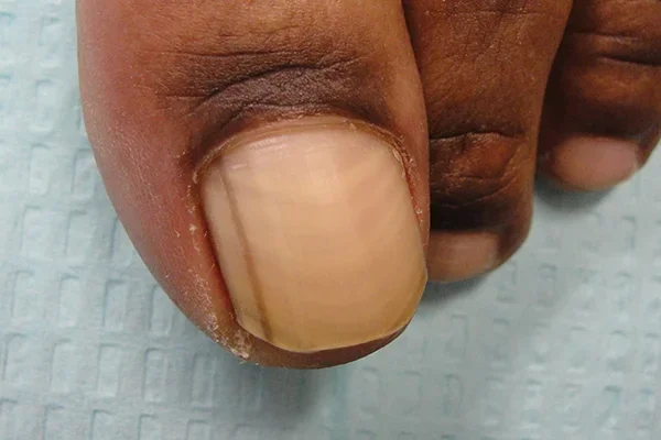 Pre-treatment