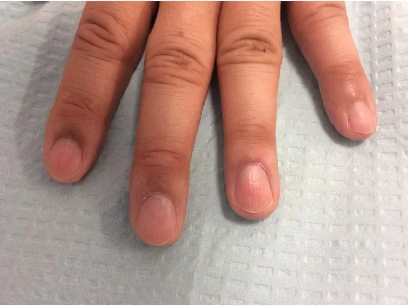 Post-treatment