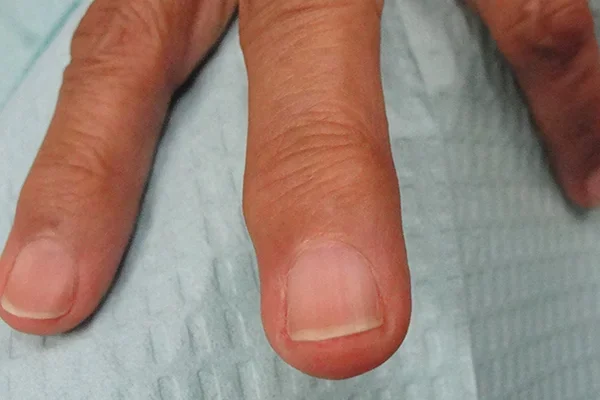 Post-treatment