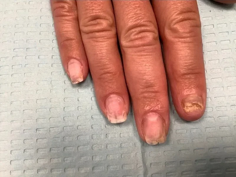 Pre-treatment