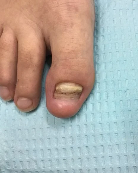 Toenail Dystrophy & Retronychia Treatment