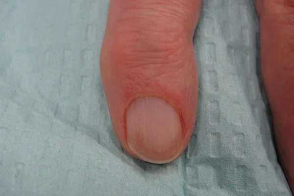 Post-treatment