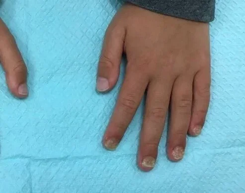 Pre-treatment