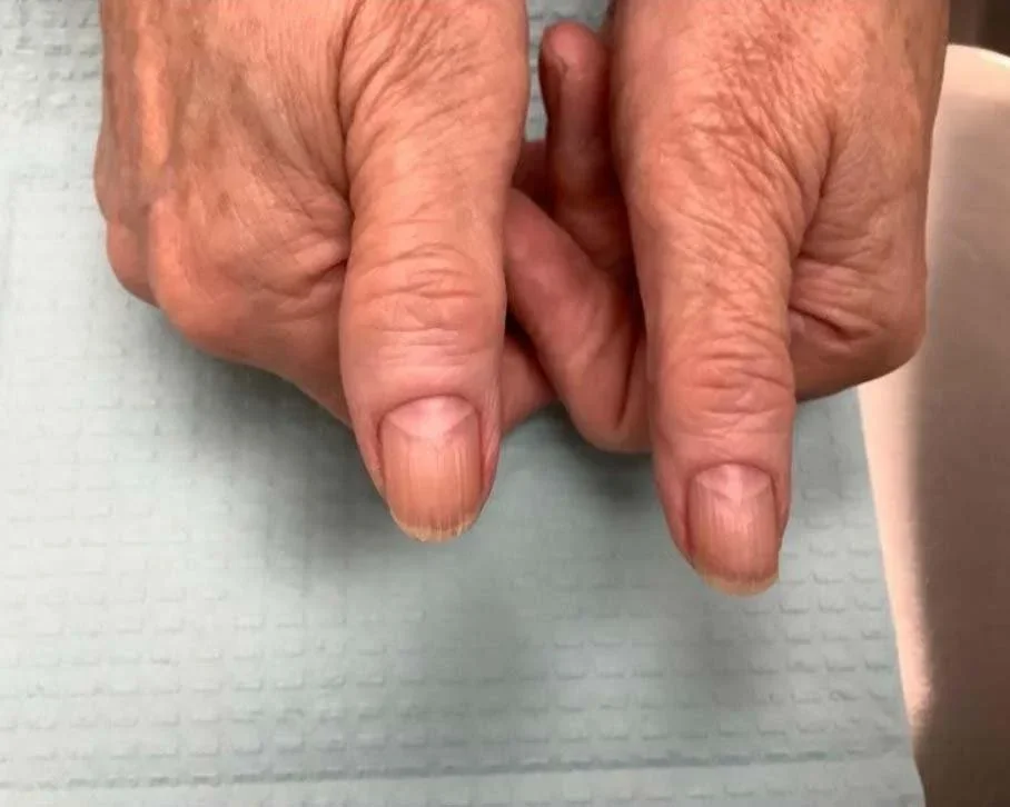 Post-treatment