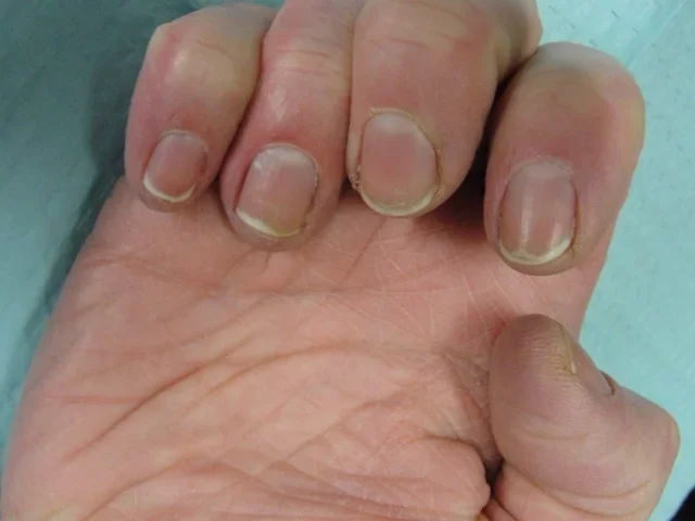 Post-treatment
