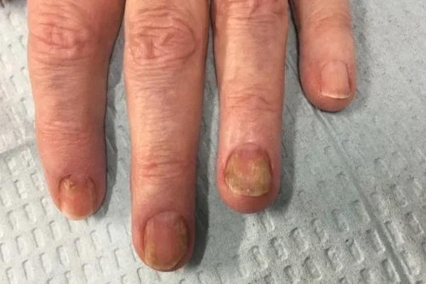 Pre-treatment