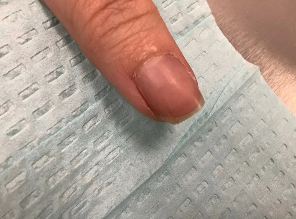 Post-treatment