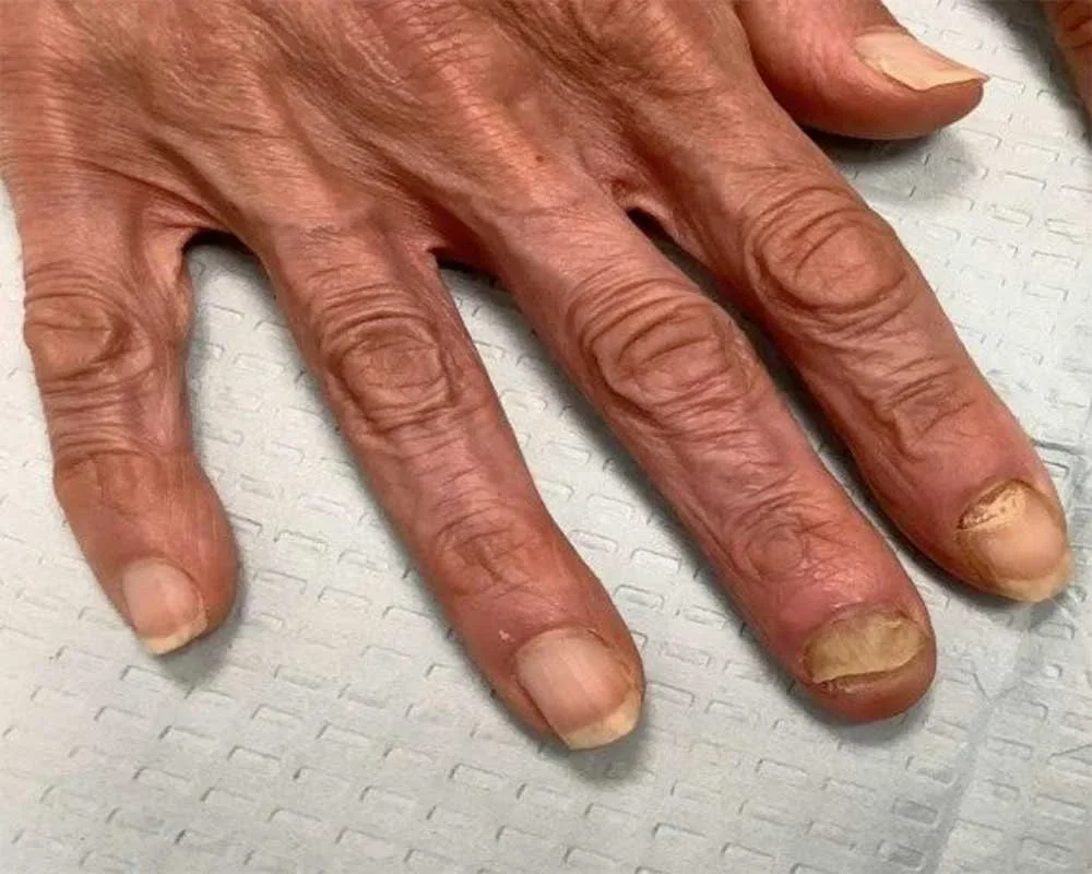 Pre-treatment