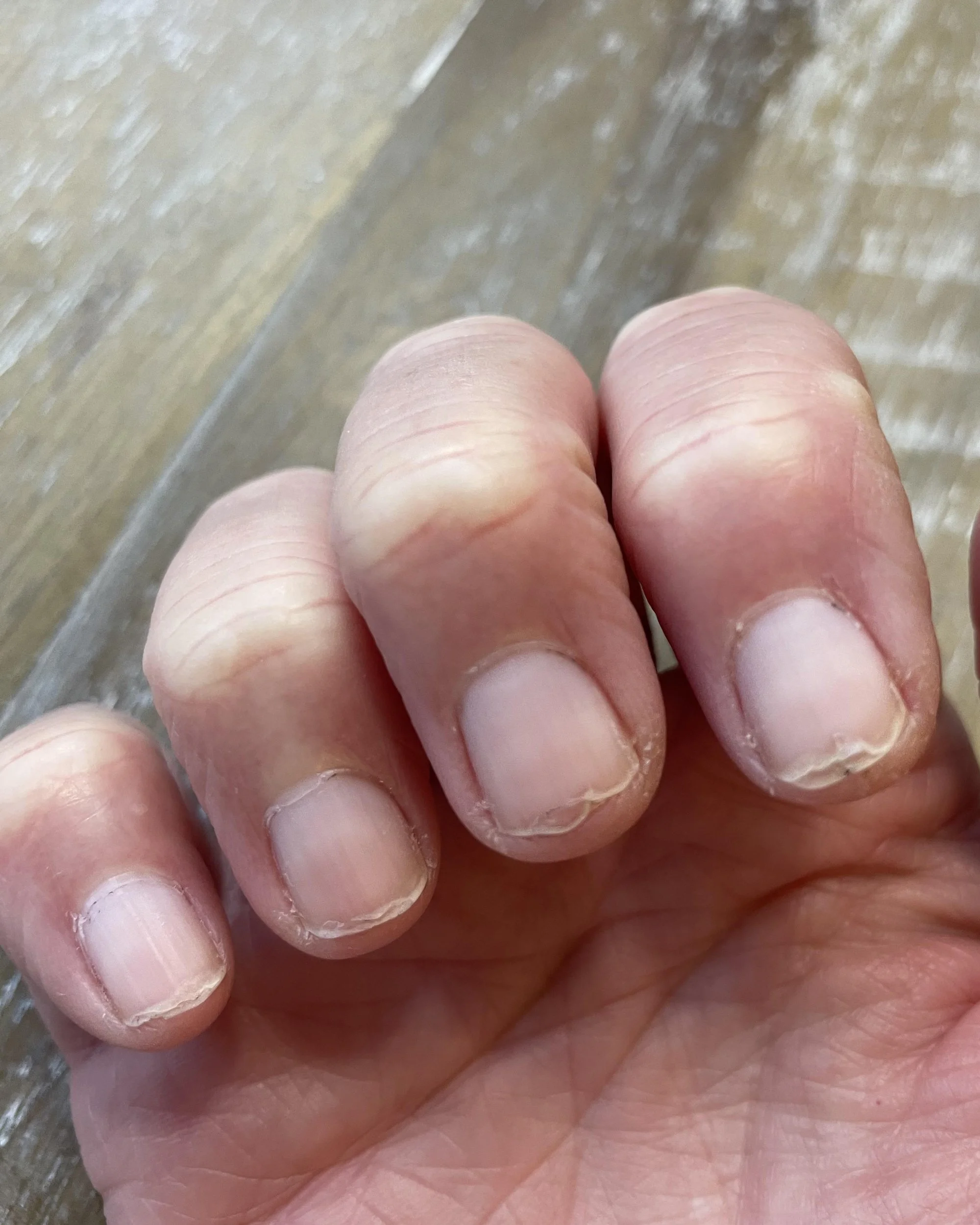 Brittle Nails Treatment