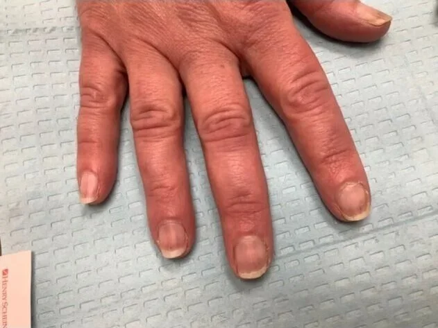 Post-treatment