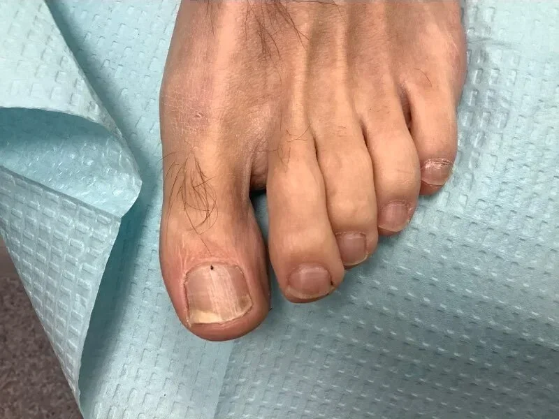 Post-treatment