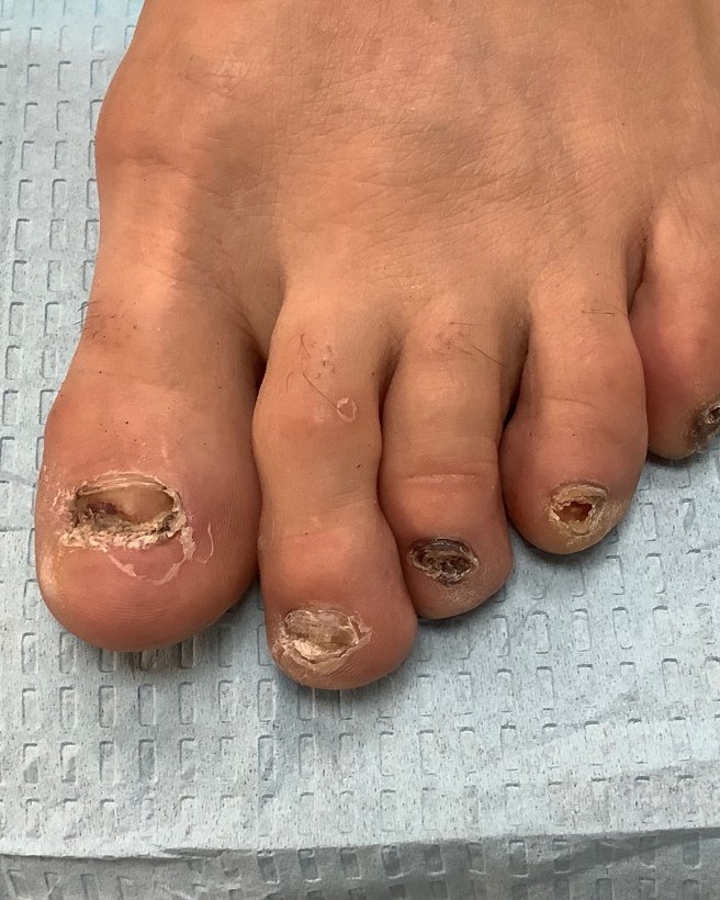 Nail Trauma and Nail Bed Injury from Sports or Nailcare