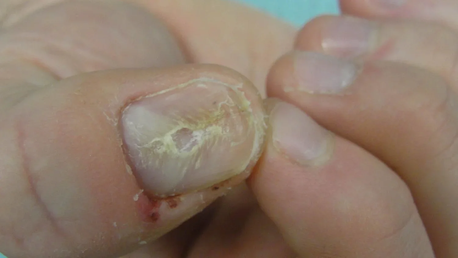 Pre-treatment
