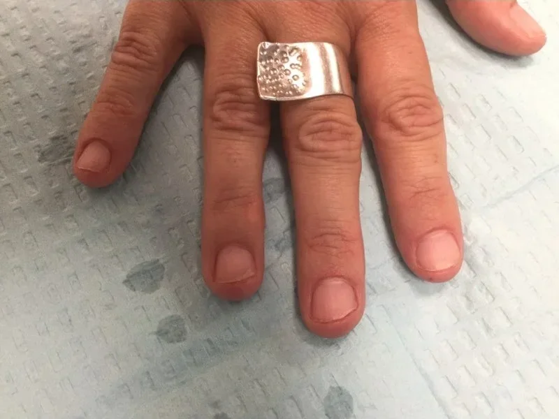 Post-treatment
