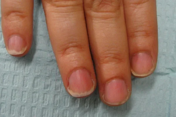 Post-treatment