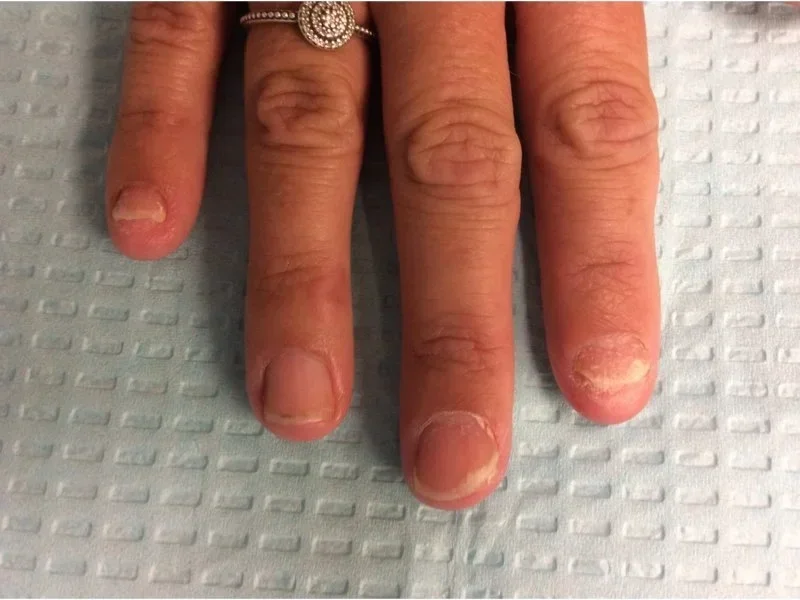 Pre-treatment