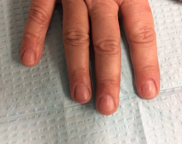 Post-treatment