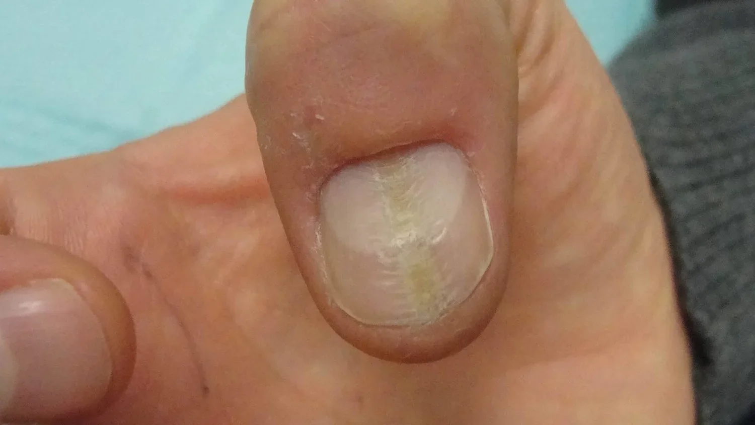 Pre-treatment