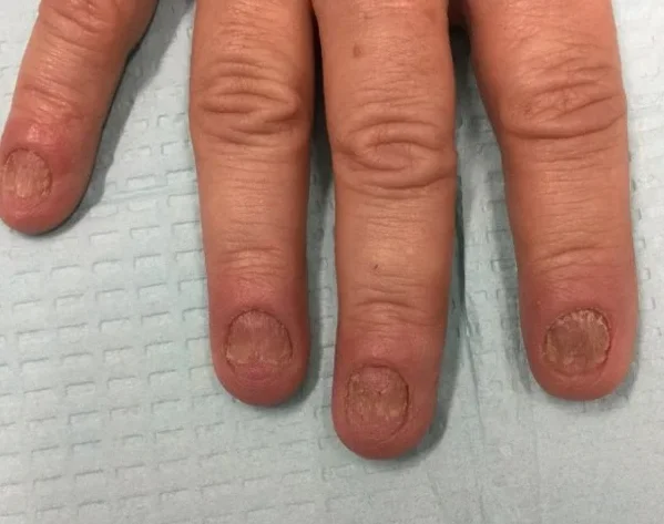 Pre-treatment