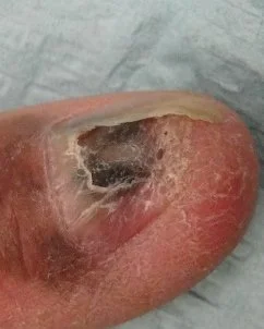 Nail Cancer Treatment