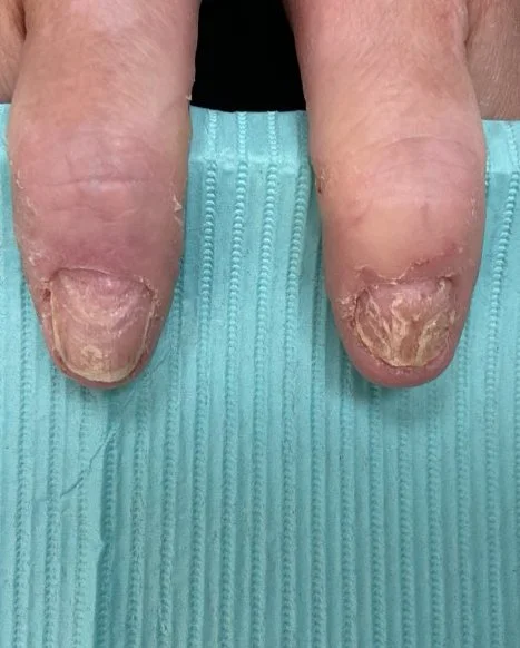 Nail Eczema Treatment