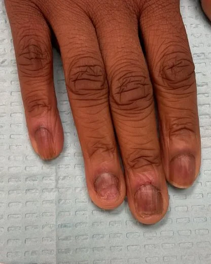 Nail Lichen Planus