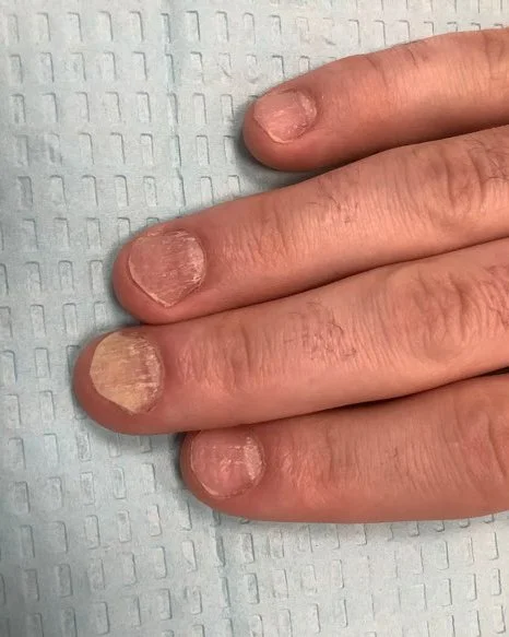 Nail Psoriasis