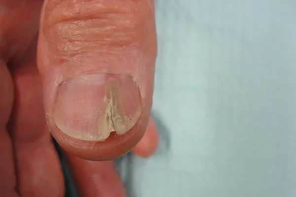 Pre-treatment