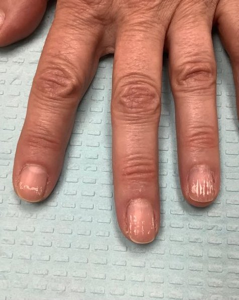 White Spots (Leukonychia) On The Nails Treatment