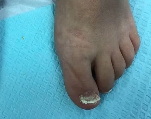 Pre-treatment