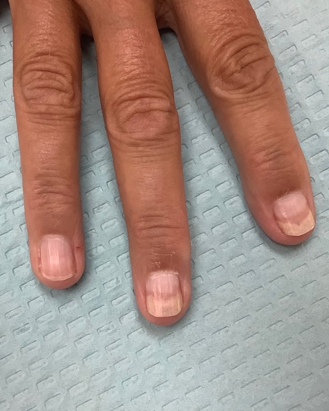 Nail Separation Treatment