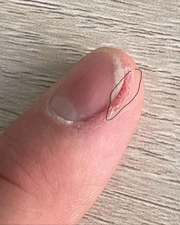 Periungual Warts & Subungual Warts
