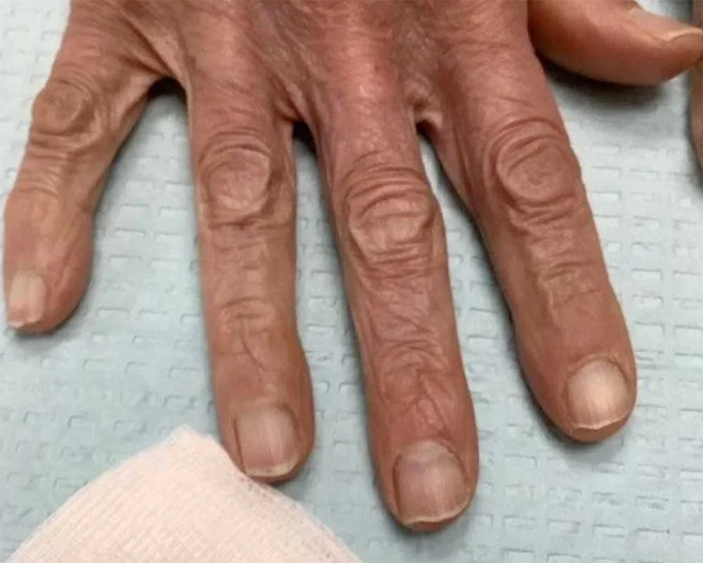 Post-treatment