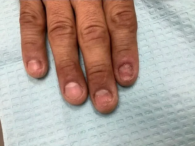 Pre-treatment