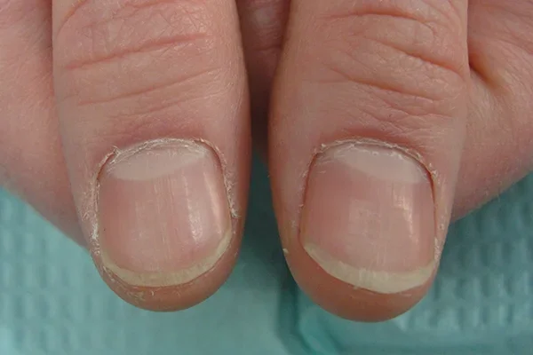 Post-treatment