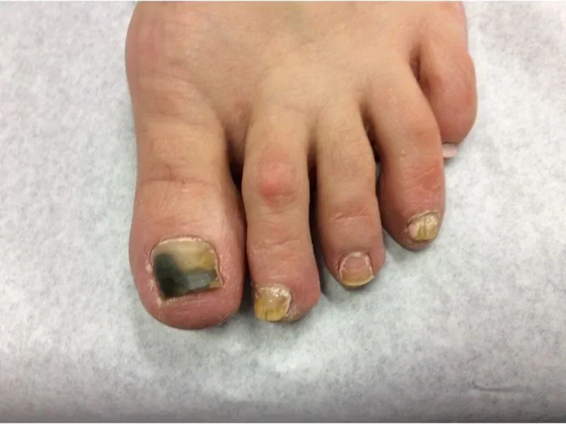 Pre-treatment