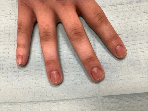 Post-treatment
