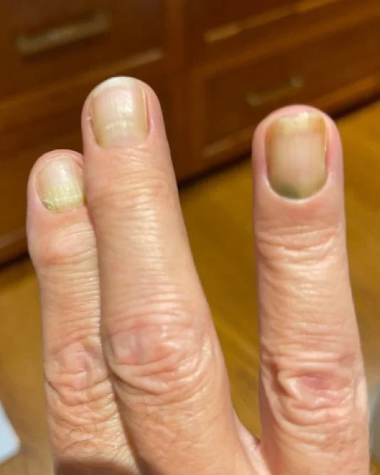 Salon & Nail Product Induced Nail Issues