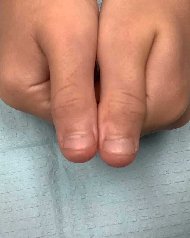 Nail Biting Treatment - Onychophagia