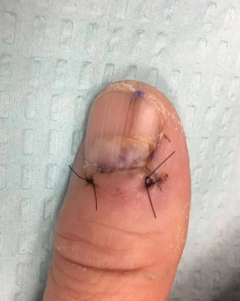 Nail Biopsy Guidance