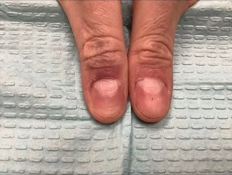 Post-treatment