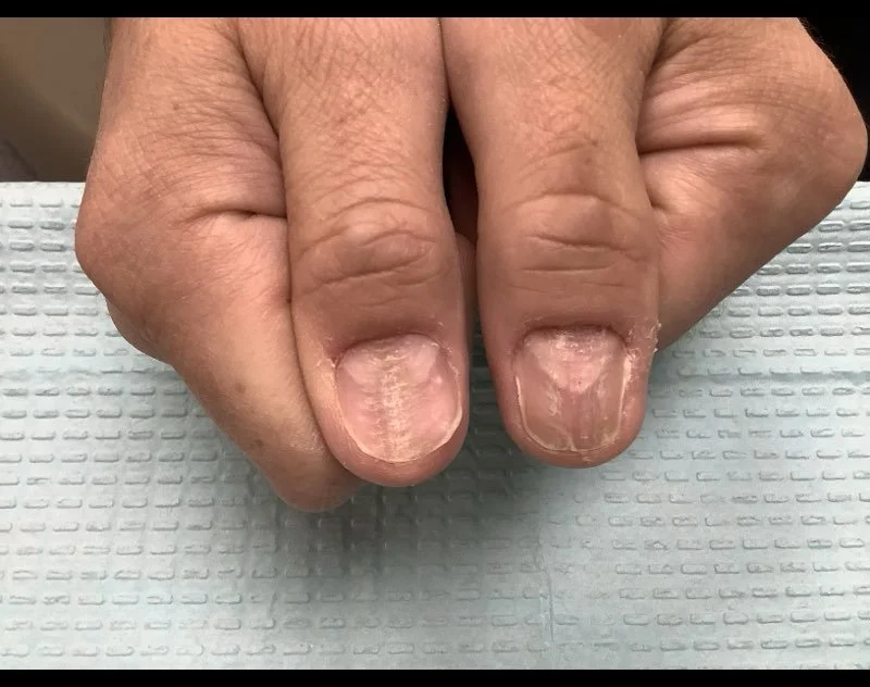 Pre-treatment