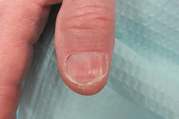 Post-treatment
