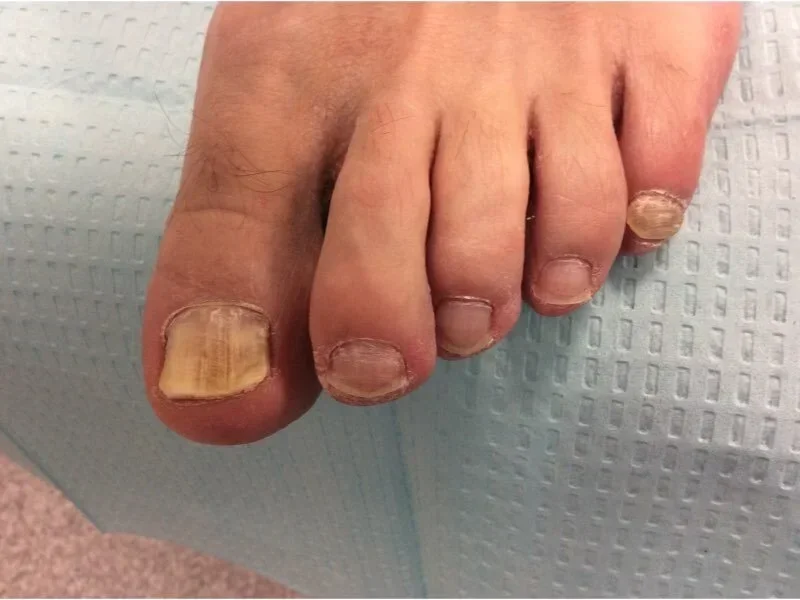 Nail Fungus Treatment