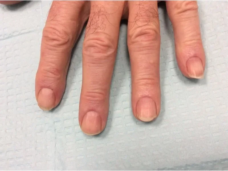 Post-treatment